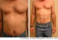 Ab Implants