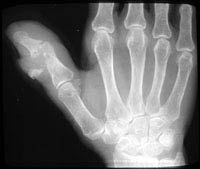 Osteoporotic Bones