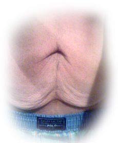 Loos Skin on Fatty