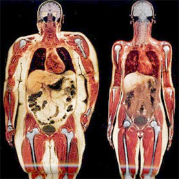 Subcutaneous Fat vs Visceral Fat & NAFLD: What to Know