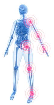 Hunch Back Posture Problems - HELP Kyphosis Causing Muscle Imbalance